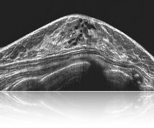 Breast Ultrasound image